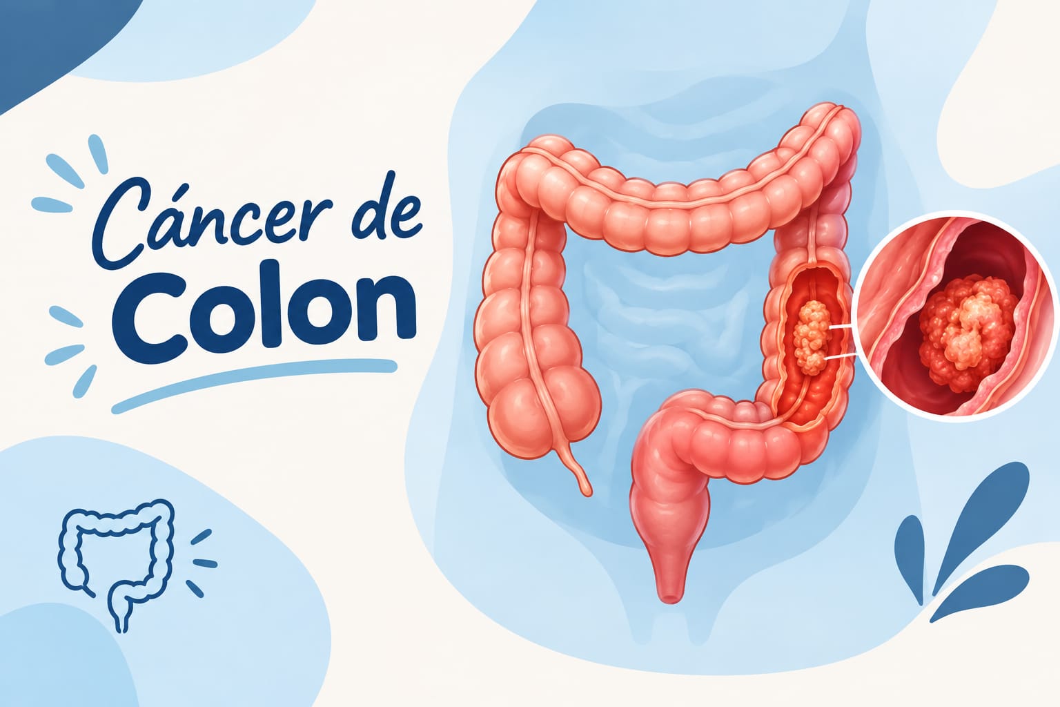 Ilustración del intestino grueso con un tumor ampliado