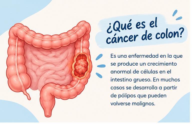 ¿Qué es el cáncer de colon? Crecimiento anormal de células en el intestino grueso